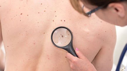 Cilt Kanseri Artışı Hızlı