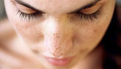 Güneş Lekeleri Çözümü