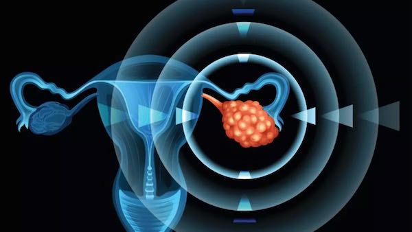 Kadın Katili Yumurtalık Kanseri