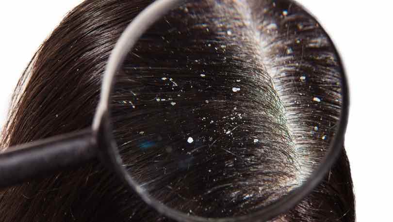 Kepek Kontrol Altında