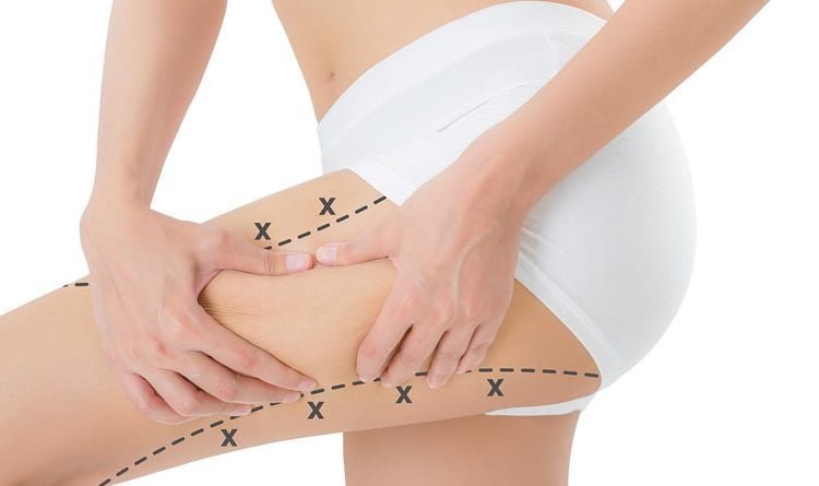 Mezoterapi Selülit Kurtarıcısı mı?