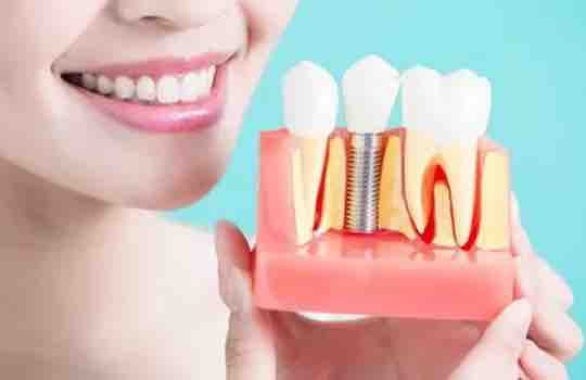 İmplant ile Hayata Devam