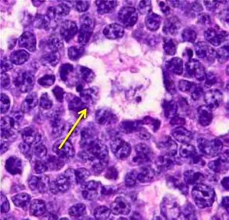 Lenf Şişliği Lenfoma Olabilir