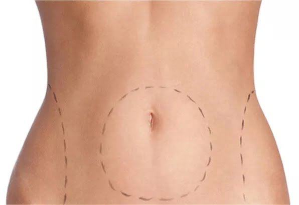 Liposuction ile Çekici Görünüm