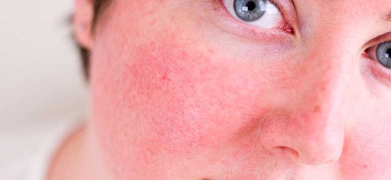 Yüzdeki Kızarıklığı Ciddiye Alın