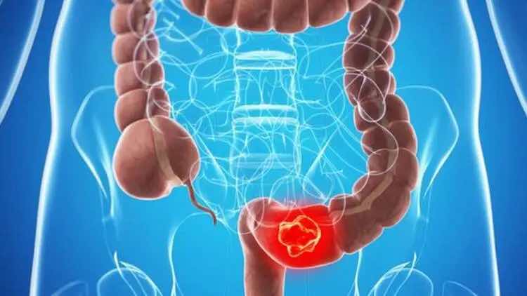 Kalınbağırsak Kanseri