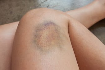 Ciltteki Morluk Tehlikeli mi