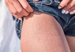 Mezoterapi Kurtarıcı mı