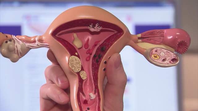 Ameliyatsız Miyom Tedavisi