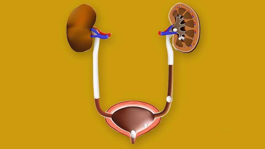 Erkeklerde İdrar Yolu Taşı