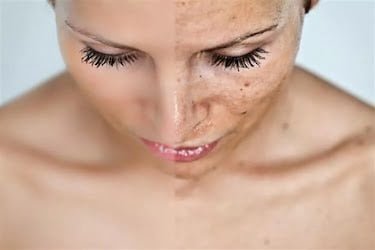 Cilt Lekelerinden Kurtulma