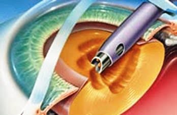 Katarakt Cerrahisi Laser Dönemi