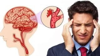 Baş Ağrısı Beyin Kanaması mi?