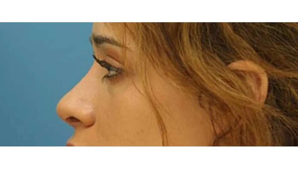 Burun Düşmesi Tehlikesi