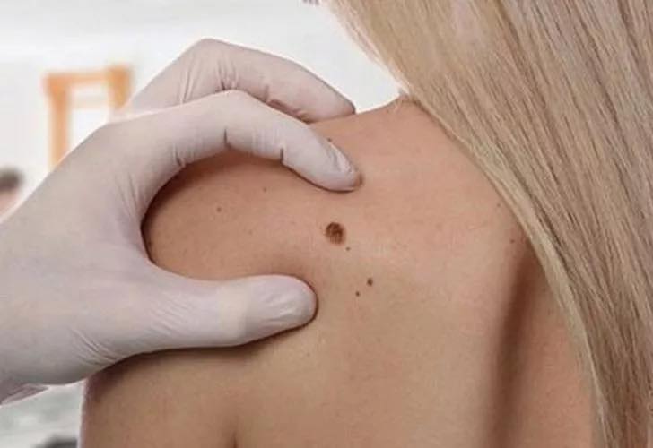 Cilt Kanseri Artıyor