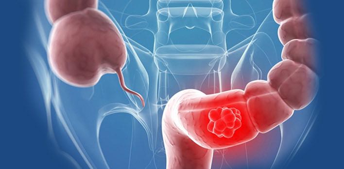 Kolon Kanseri Taraması