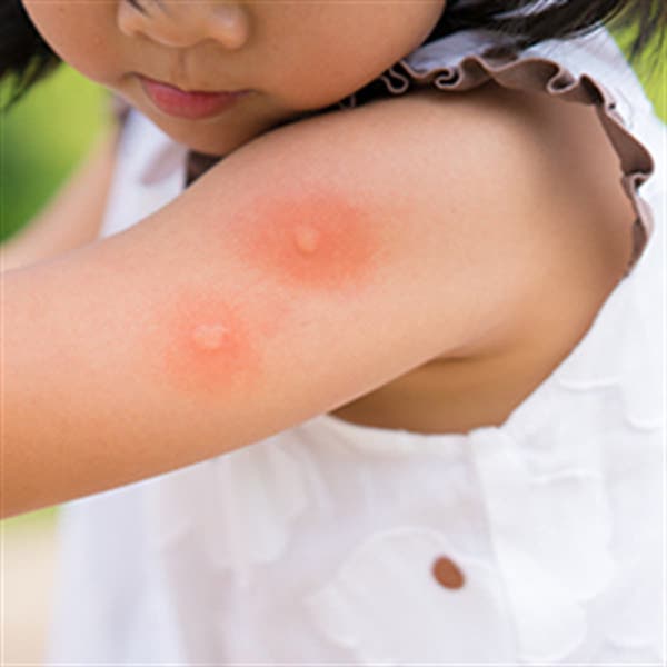 Böcek Isırık Lekesi
