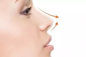 En Popüler Rinoplasti