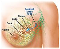 Kalıtsal Meme Kanseri Nedir?
