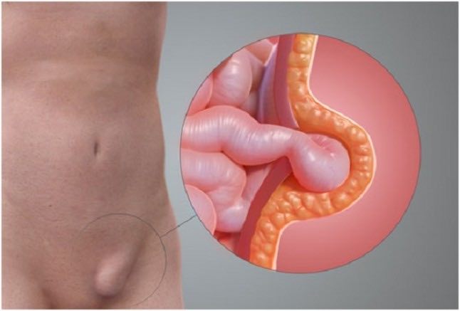 Kabızlık-Öksürük Fıtık Nedeni