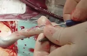 Kordon Kanı ile 80 Hastalık Tedavisi