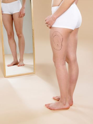 Ayak Bileğine Liposuction