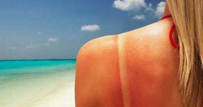 Güneş Yanığına Pratik Çözümler