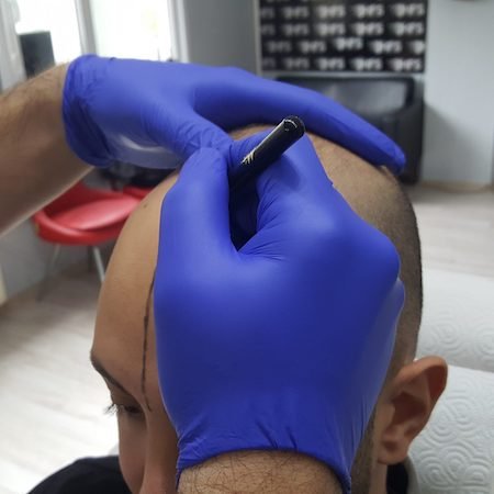 Kellik İçin 3 Boyutlu Çözüm
