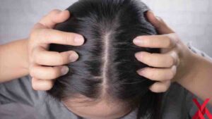 Covid Sonrası Saç Dökülür mü?