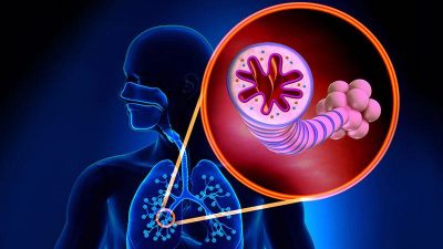 KOAH Hastaları Erken Tanı Alamıyor