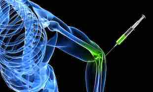 Proloterapi ile Ağrıya Doğal Çözüm