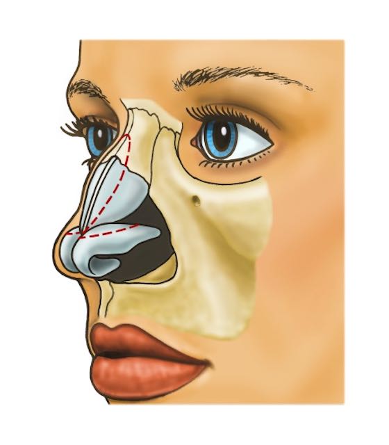 Ses Dalgalarıyla Burun Estetiği